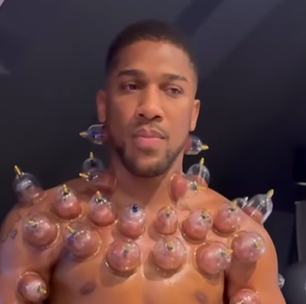 Pugilista Anthony Joshua impressiona seguidores com tratamento com ventosas