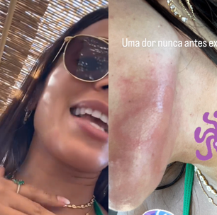 Anitta sofre ataque de água-viva durante passeio em Ibiza: "Fui eletrocutada"