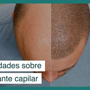 5 curiosidades que você não sabia sobre transplante capilar