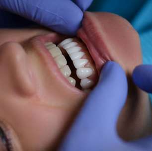 Lente de contato dental e faceta de porcelana: necessidade ou modinha?