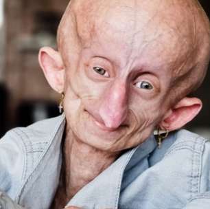 O que é progeria? Jovem de 19 anos morreu após doença do envelhecimento precoce