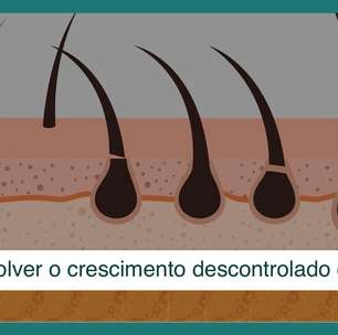 Disfunções hormonais causam crescimento descontrolado de pelos: como resolver