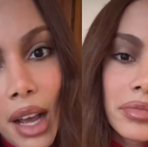 Sem 'pé na cova', sem cara 'desfigurada': Anitta fala pela 1ª vez sobre nova plástica no rosto. 'Eu sempre fiz, mas'