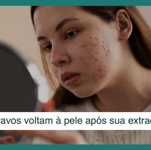 Cravos são invencíveis? Por que retornam à pele após extração?