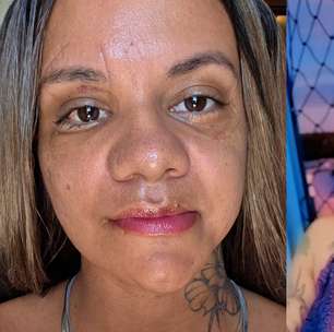 Vítima de 61 socos do ex-namorado mostra recuperação após cirurgia facial e recebe apoio nas redes