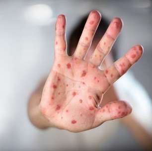 Cidade do interior de SP enfrenta surto da doença mão-pé-boca; saiba os sintomas e como prevenir