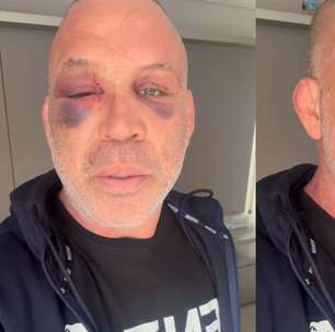 Wanderlei Silva mostra sequelas de confusão generalizada após luta contra Popó