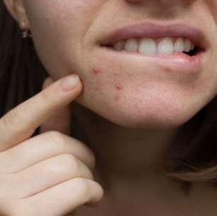 Alimentos que provocam acne; quais são e o que fazer para evitar a condição