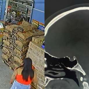 Mulher atingida por bala perdida teve projétil alojado a 4 mm da medula cervical e escapou da tetraplegia: 'Chegou andando'