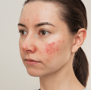 Estresse: veja como seus efeitos se refletem na nossa pele