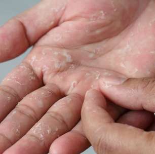 Bolhas nos pés e nas mãos pode ser disidrose; conheça problema