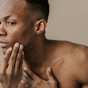 Pesquisadores brasileiros pretendem usar IA para diagnosticar câncer em peles negras