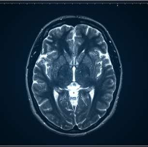 Exames de imagem serão aliados em tratamentos contra depressão; entenda