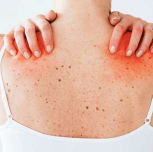 Alergia à carne causada por picada de carrapato: o que você precisa saber