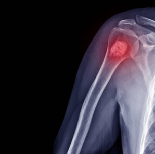 Medicamento pode aumentar as taxas de sobrevivência de crianças com câncer ósseo raro