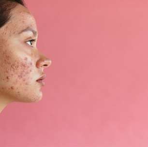 O verão está chegando! Veja como cuidar da acne na estação