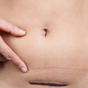 Por que algumas cicatrizes viram queloides?