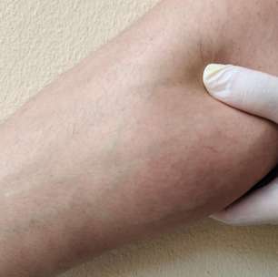 Calor piora o lipedema? Verão aumenta dor e inchaço