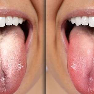 Língua esbranquiçada: descubra os motivos e como cuidar da sua saúde bucal