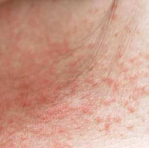 Câncer de pele: como identificar sinais suspeitos