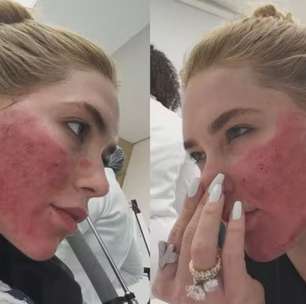 Especialista faz alerta após Virginia surgir com rosto em carne viva: 'Deve evoluir'