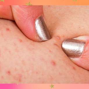 Tudo o que você precisa saber para evitar pelos encravados