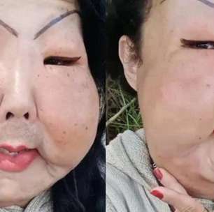 Uma nova mulher! Juju do Pix exibe evolução facial após cirurgia para remoção de óleo industrial; veja