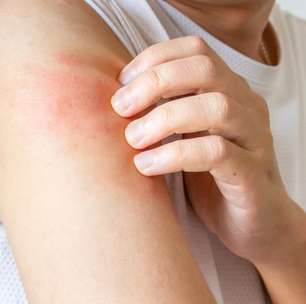 Calor e umidade aumentam casos de micoses no verão