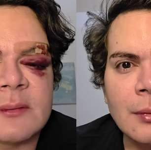 Médico tem apartamento invadido e é espancado por vizinho no Recife: 'Covardia'