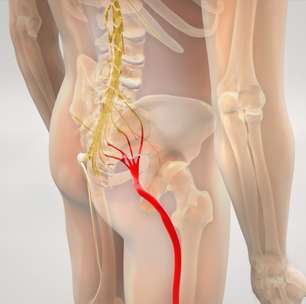 Dor no ciático: saiba o que causa e como tratar o problema