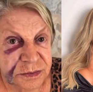 Poliana passa por susto após queda da mãe, que aparece com olho roxo