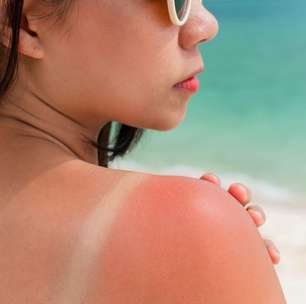 Protetor solar vencido: vale a pena usar ou é perigoso?