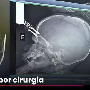 Criança de 1 ano fica com carregador cravado na testa após cair da cama em MG