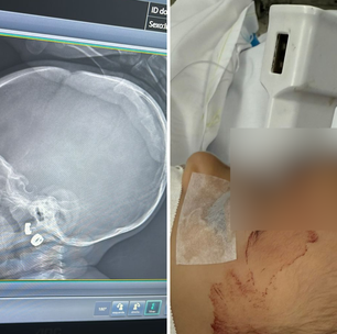 Criança de 1 ano cai da cama e fica com carregador cravado na testa em MG; veja fotos