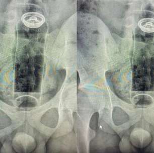 Jovem de 19 anos é internado após objeto ficar preso no ânus