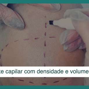 Transplante capilar com densidade e volume natural: conheça o método DVN