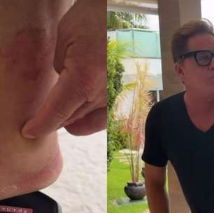 Leonardo diverte a web ao culpar 'cachaça' por pé inchado e dá resposta sincerona a Poliana