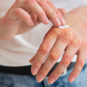 Mpox no Brasil: doença pode matar? Conheça os sintomas