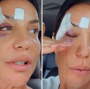 Ivete Sangalo surge com o rosto cheio de hematomas após internação: 'É difícil'