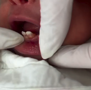Bebê nasce com dentes no ES e passa por cirurgia de extração aos seis dias de vida