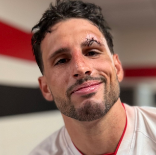 Calleri leva 8 pontos na sobrancelha após choque em São Paulo x Cruzeiro