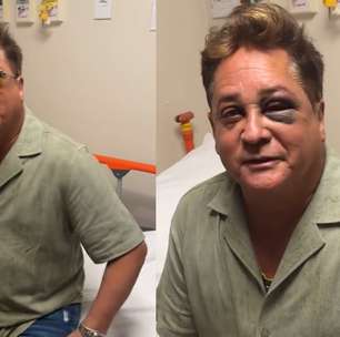 Leonardo sofre acidente e aparece com olho roxo nas redes sociais: 'Não está muito bonito'