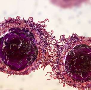 Novo tratamento com pembrolizumabe pode manter pacientes com câncer colorretal livres da doença por anos