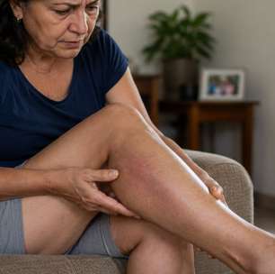 Nem toda trombose começa de forma grave e isso faz muita gente ignorar os sinais