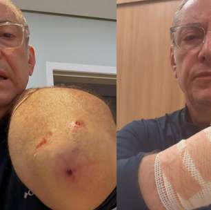 Veja o ferimento em âncora da Globo atacado por pitbull sem focinheira em SP