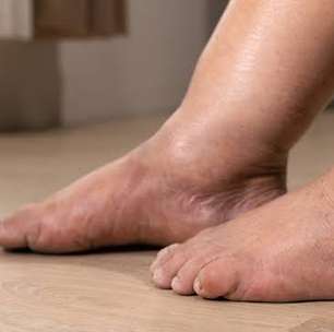 Lipedema: por que o diagnóstico ainda demora