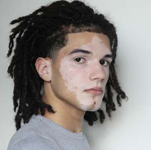 De vendedor de água no farol a modelo: jovem com vitiligo assina com agência de Alessandra Ambrósio