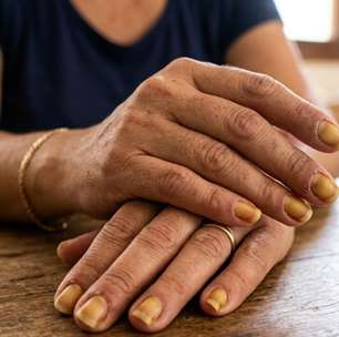 Unhas amareladas: veja as causas que vão além do esmalte