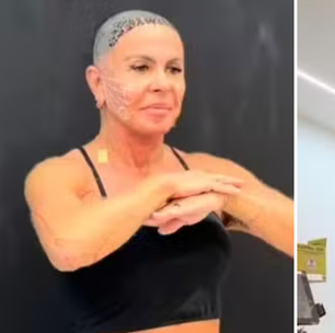 Gretchen faz procedimentos no rosto e no corpo após transplante capilar: 'Resultado incrível'