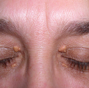 Estudo aponta que manchas amareladas nos olhos podem indicar risco de AVC